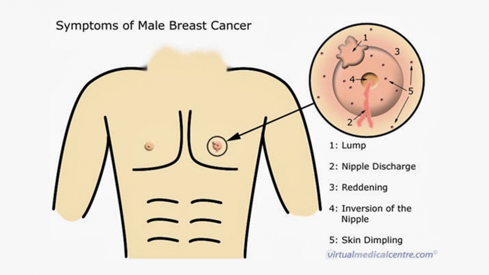 Male Breast Cancer: The Disease No One's Talking About