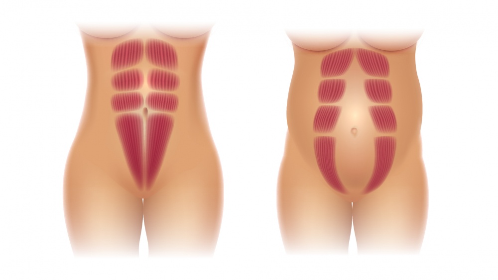 workout for women with Diastasis Recti Abdominis or â€œseparated absâ€